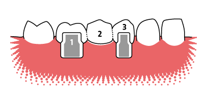 Veranschaulichung des Aufbaus einer Zahnbr&uuml;cke